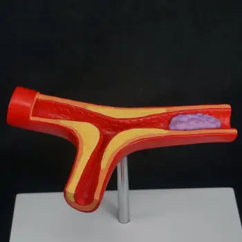 ПВХ Артериальный Атеросклероз Человека Модель Артериосклероза Тромб Сосудистая Медицинская Модель 2